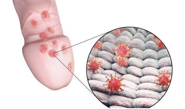 Allergie gegen Penisvergrößerungsgel