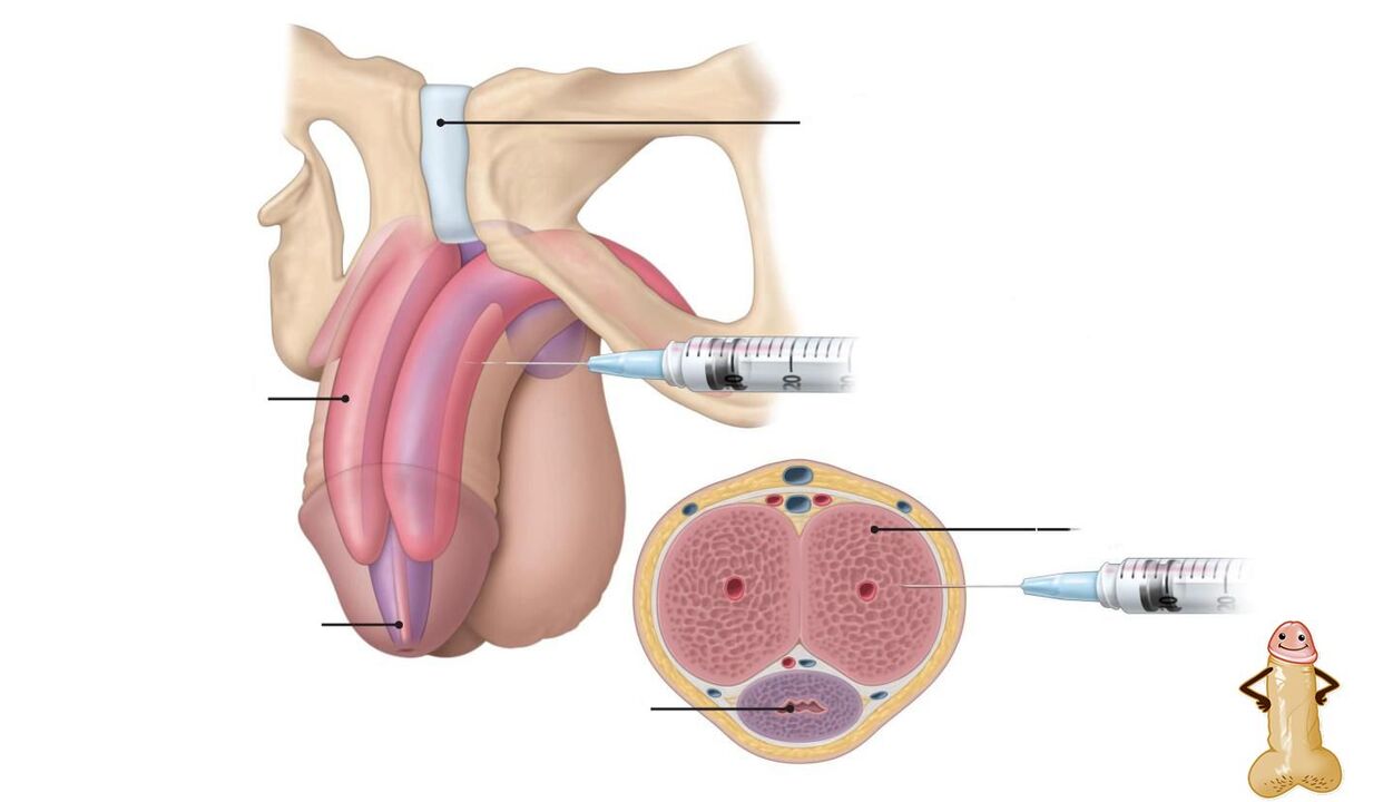 Injektionen von Hyaluronsäure zur Penisvergrößerung